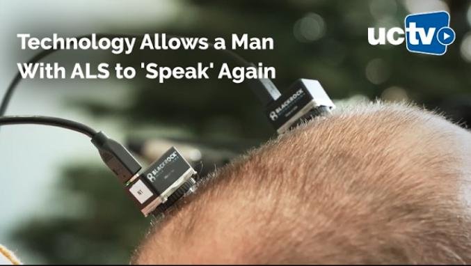 Brain-computer interface connectors on Casey Harrell's head, UC Davis